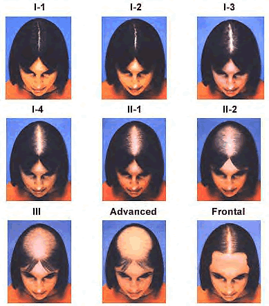 Woman Pattern Hair Loss