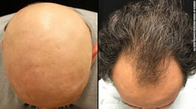 Tofacitinib Hair Growth results